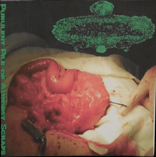 Urinary Tract Infection From Severe Pus Clots : Purulent Pile Of Autopsy Scraps Urinary Tract Infection From Severe Pus Clots : Purulent Pile Of Autopsy Scraps